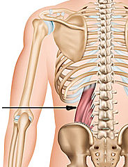 Back pain - quadratus lumborum